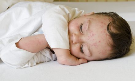 Chickenpox Vaccination Now Available At Superdrug